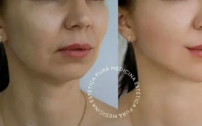 La Radiofrecuencia Facial en Málaga: Innovación y Debate en la Medicina Estética